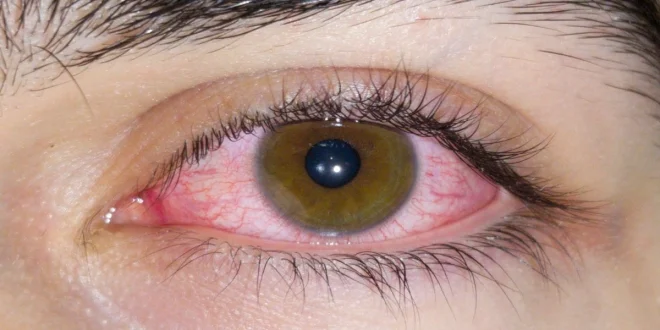 digital-eye-strain_large_1328_148.webp-e1754195781711-660x330