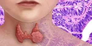 thyroid-cancer_large_1438_148.webp-e1755312399370-660x330 (1)